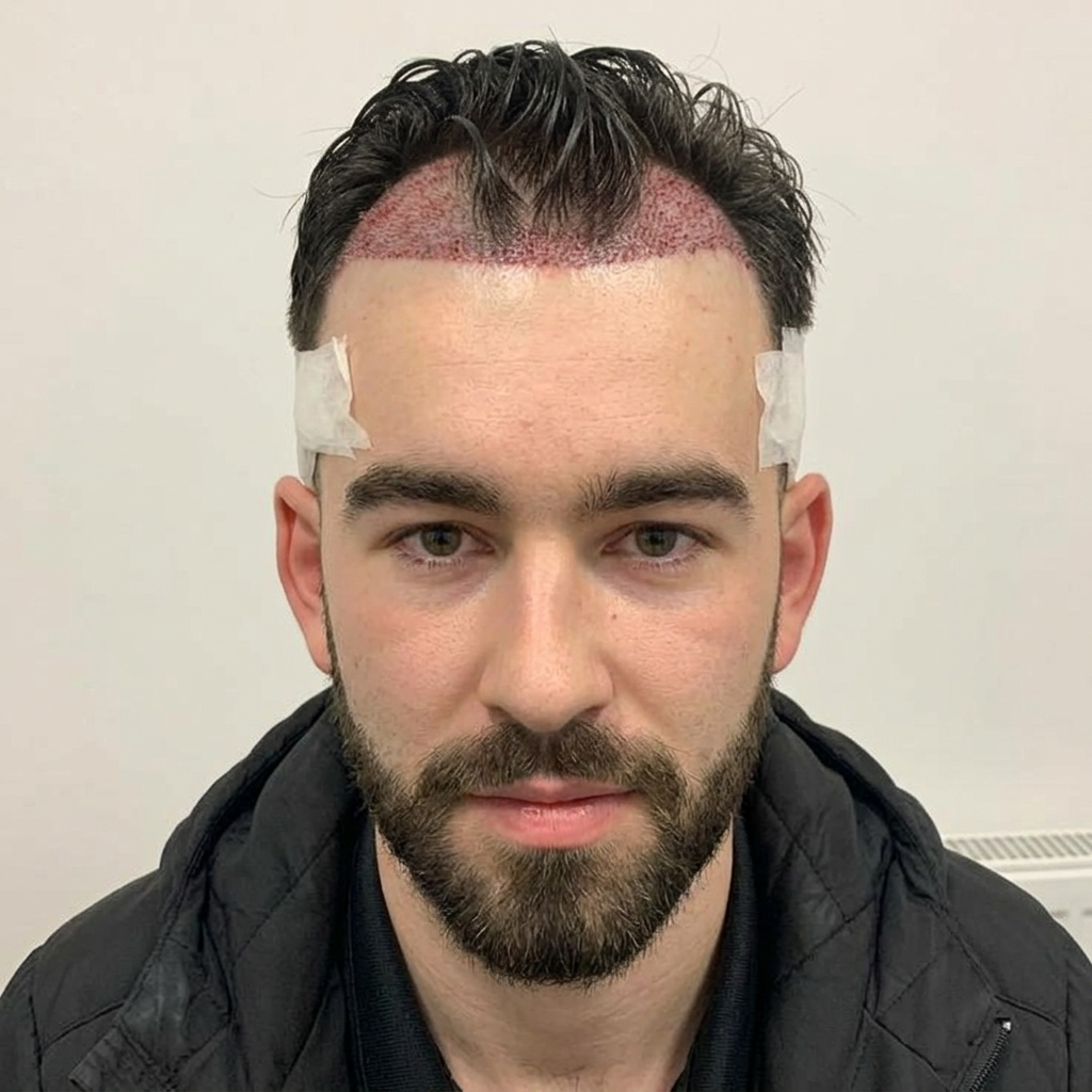 DHI hair transplant DHI hair transplant
