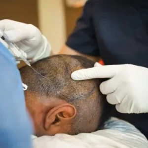 Does Crown Hair Transplant in Islamabad Grow New Hair