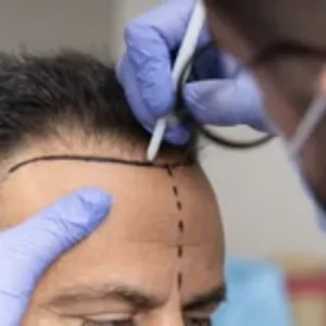 How Soon Does Hair Grow After Hair Transplant