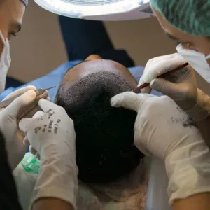 Is FUE Hair Transplant Effective After 40