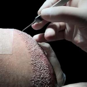 Is it normal to have pain after a hair transplant