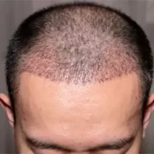 What Is the Best Age for FUT Hair Transplant
