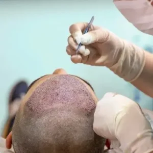 Can FUT Hair Transplant Increase Hair Volume