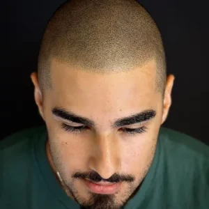 Can SMP Cover Hair Transplant Scars