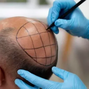 Cost of Crown Hair Transplant in Islamabad