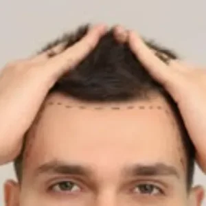 Is Scarless Hair Transplant Suitable at Any Age