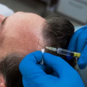 Why Are Exosomes Used for Hair Restoration in islamabad